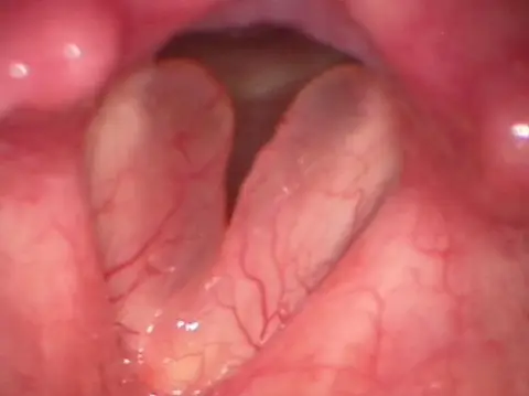 edema de cuerdas vocales