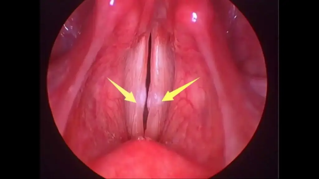 nodulos de cuerda vocal